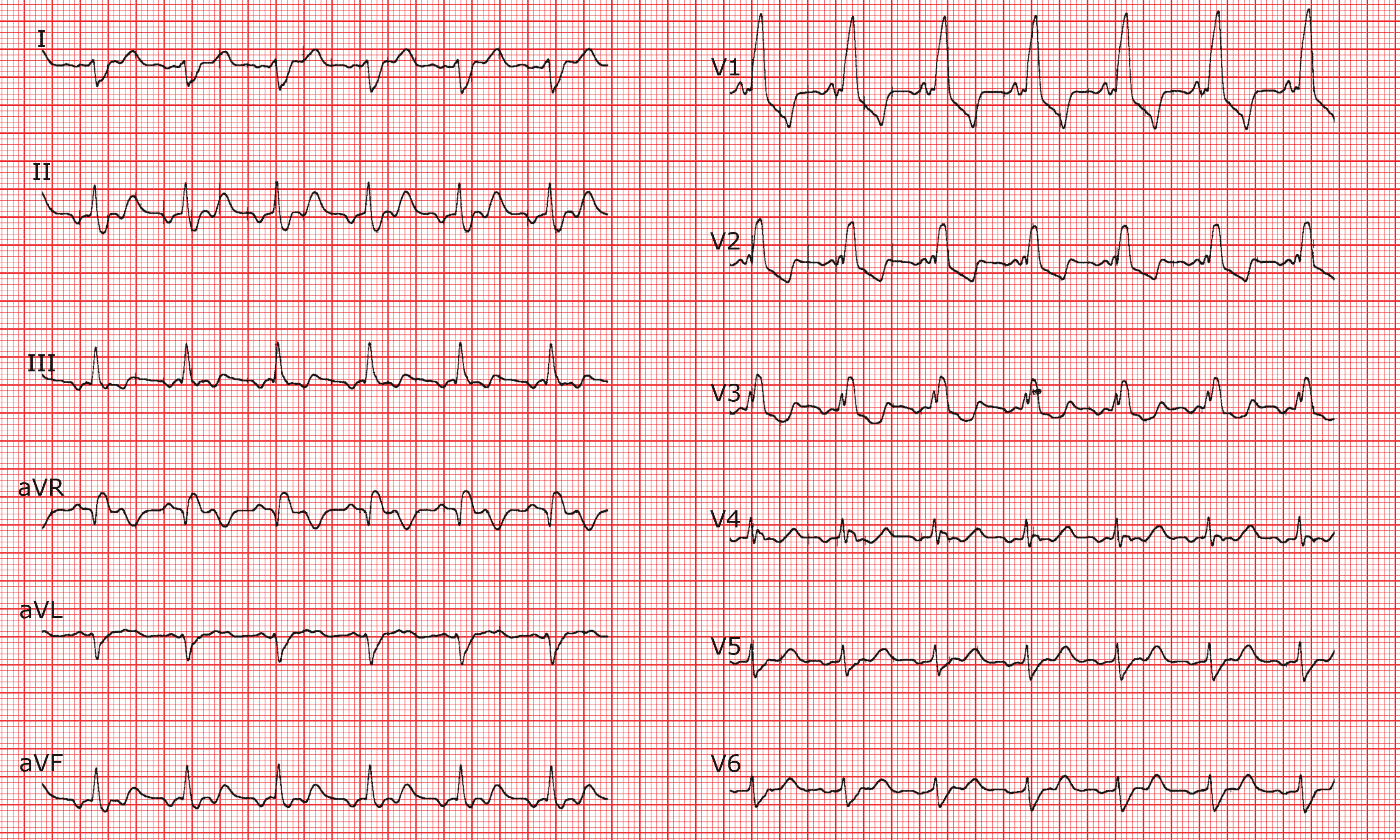Cardio Fr Atrial Flutter With Conduction And Rbbb Hot Sex Picture